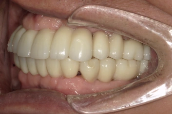 和光市　歯医者　和光市デンタルオフィス　多数歯欠損症例 治療後