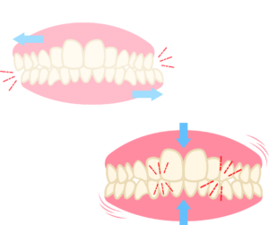 和光市　歯医者　和光市デンタルオフィス　歯ぎしり・食いしばり
